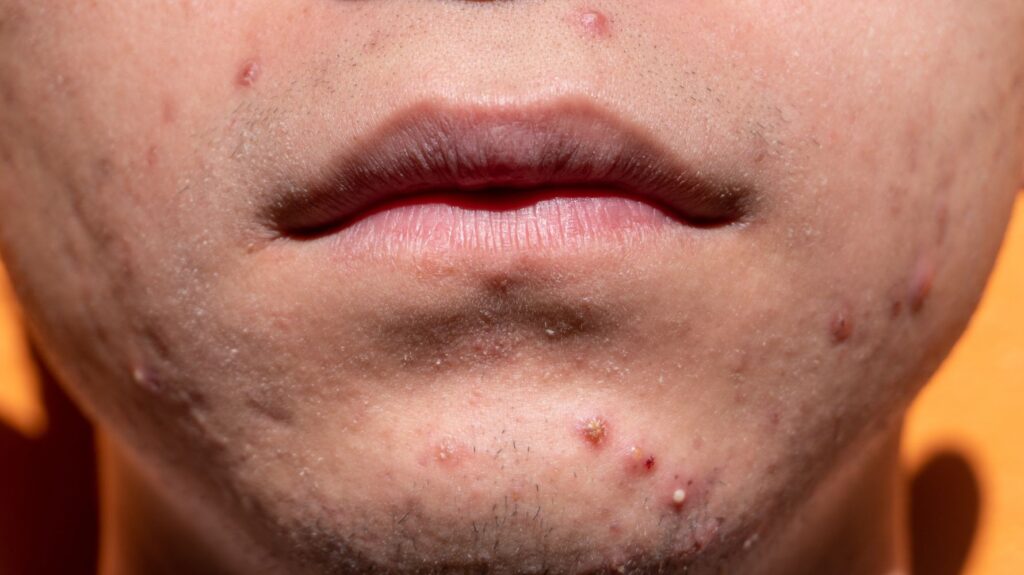 rosto de homem com ane