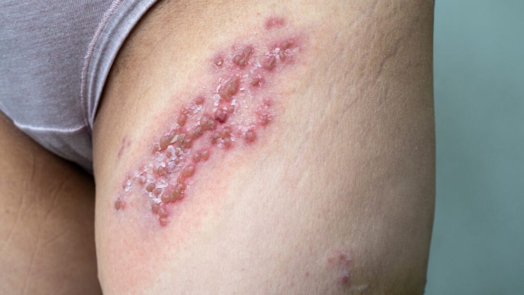 coxa de uma mulher com herpes genital