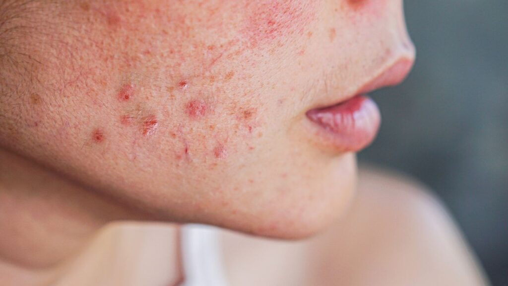 rosto em perfil com hiperpigmentação pós-inflamatória