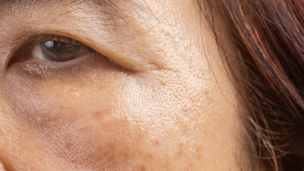 pessoa com manchas solares