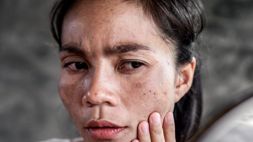 mulher com manchas no rosto