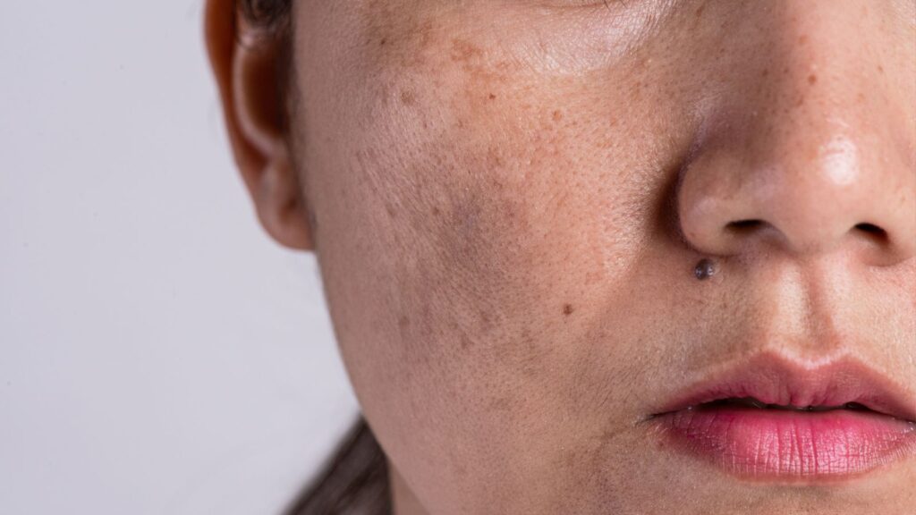 rosto com manchas de melasma