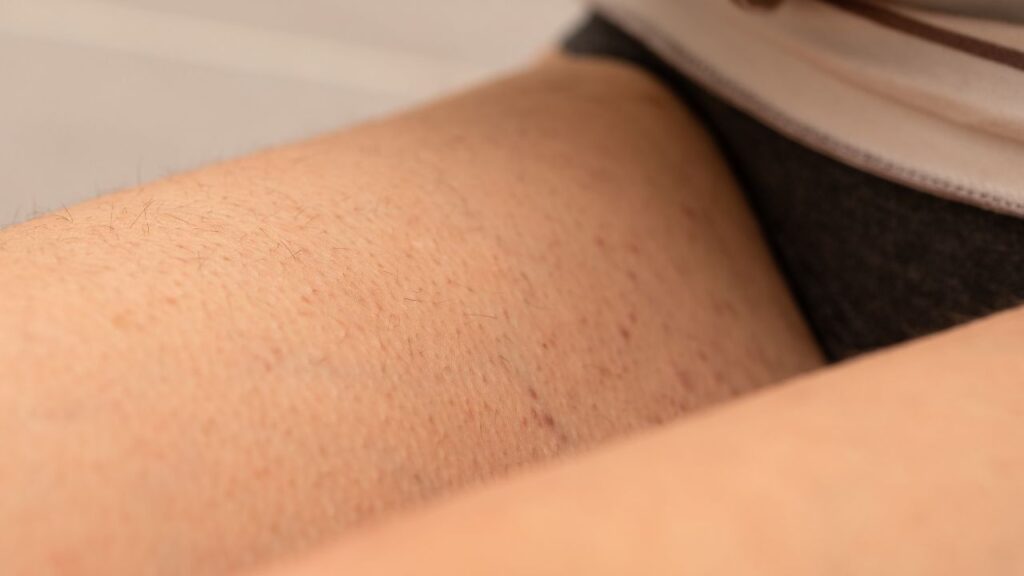 pernas de mulher com calcinha preta com bolinhas vermelhas, típicas de folicute vaginal