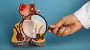 Você precisa fazer o preventivo anal? Descubra agora