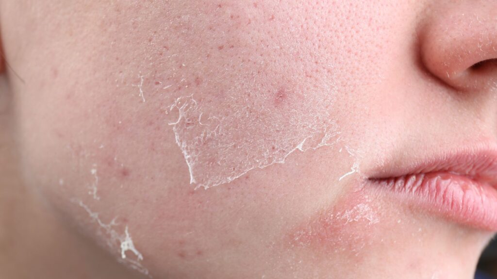 pele do rosto descascando